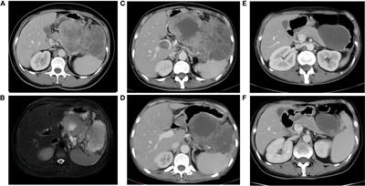 Case report: Immunotherapy in rare high TMB pancreatic acinar carcinoma